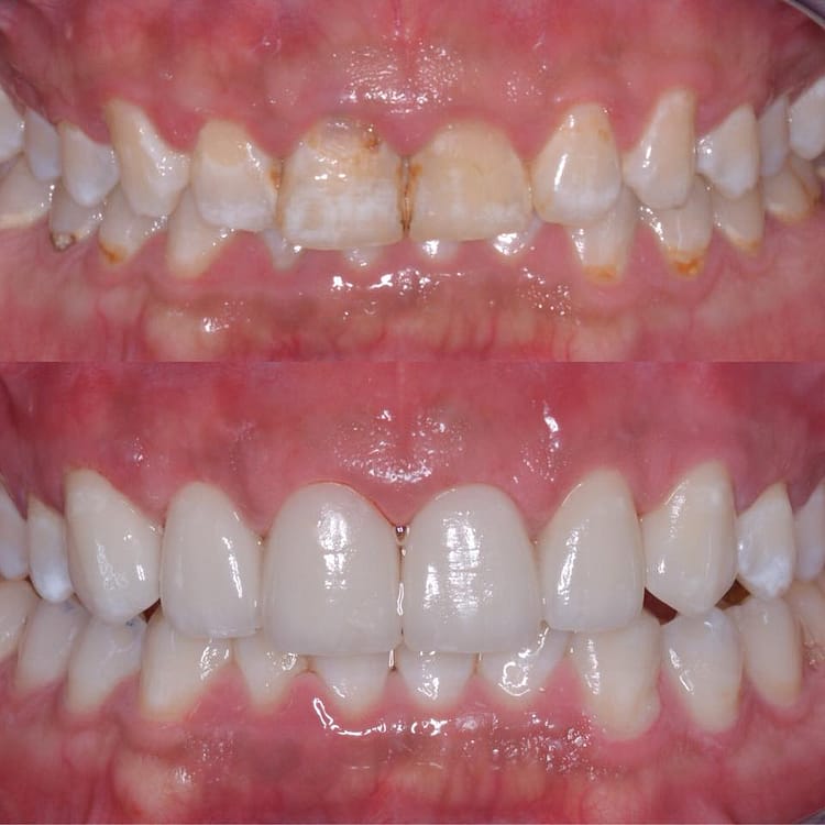 Gums Treatment in Kothrud Pune - Smile-Inn Dental Clinic