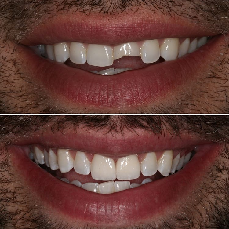 Porcelain-Crowns-Before-and-After